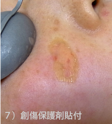 脂漏性角化症の治療ステップ7