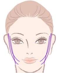 スレッドリフト挿入方法