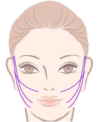 スレッドリフト挿入方法